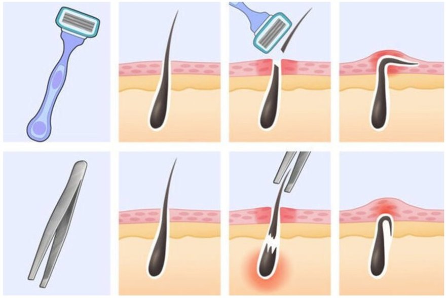Diagram comparing razor and tweezer methods of removing an ingrown hair from the skin