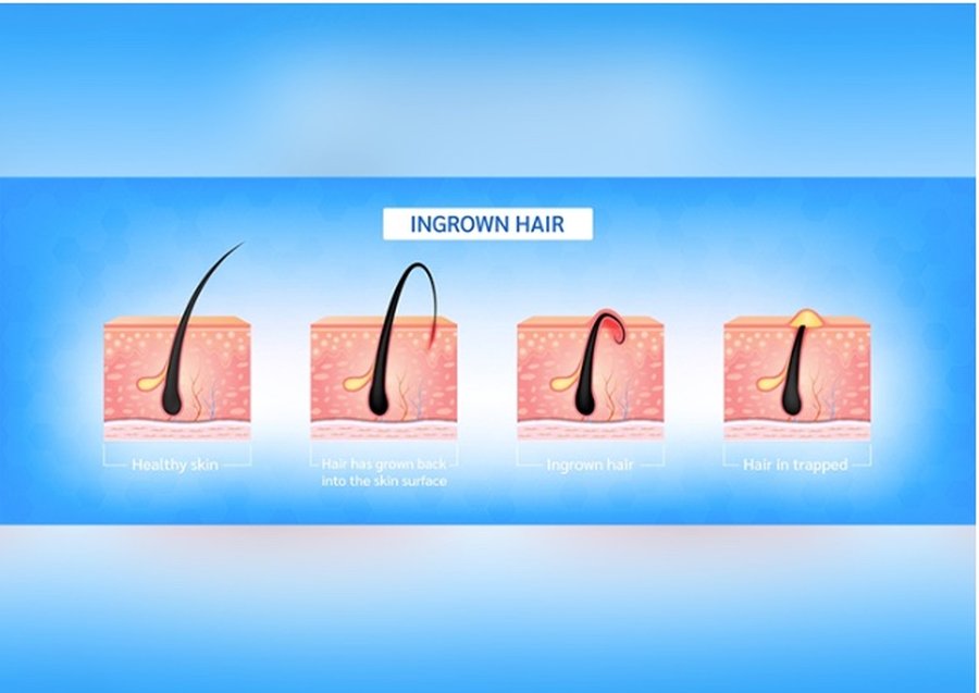 Diagram of the stages of an ingrown hair forming, from healthy skin to a trapped, inflamed hair