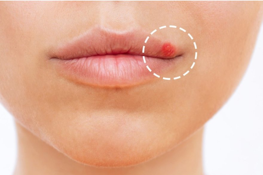A cold sore from herpes on the lip, which is sometimes mistaken for an ingrown hair