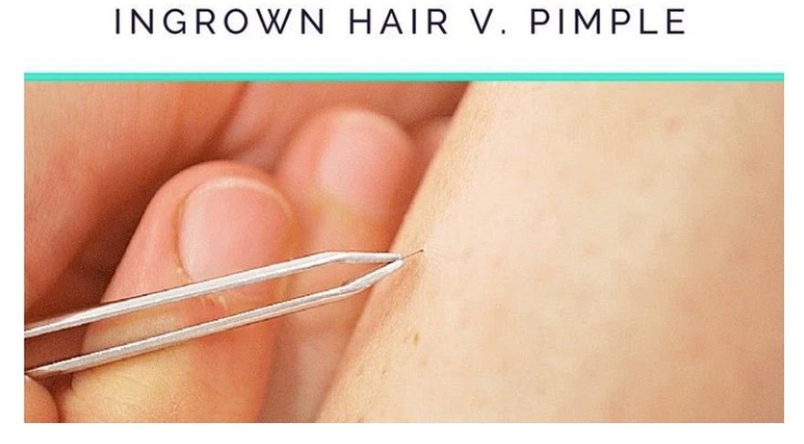 Ingrown hair versus a pimple, with tweezers beside a small bump on the skin