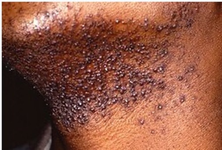 Close-up of pseudofolliculitis barbae, dense razor bumps and ingrown hairs on the beard area