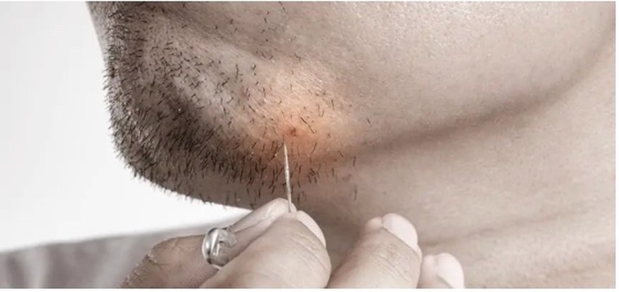 Carefully releasing an ingrown hair on the jawline with a sterile needle